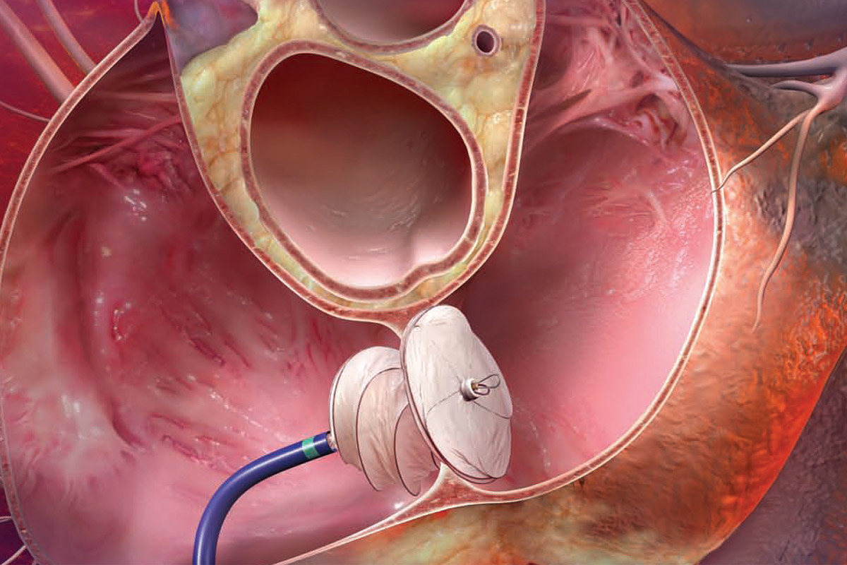 GORE HELEX Septal Occluder fixing a congenital heart defect.